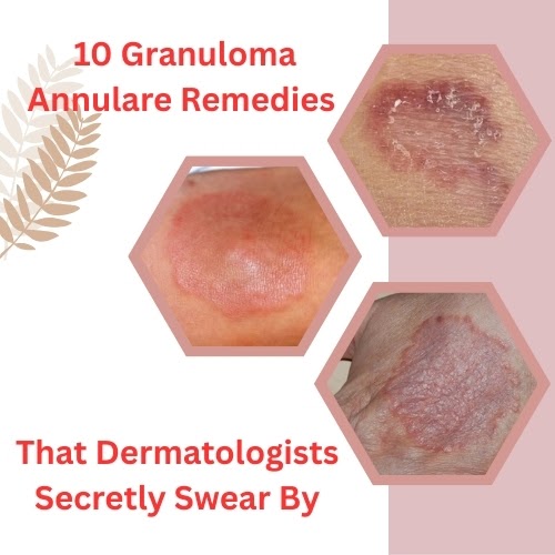 10 Granuloma Annulare Remedies That Dermatologists Secretly Swear By